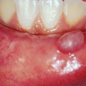 Mucocele ou Cisto de Retenção 