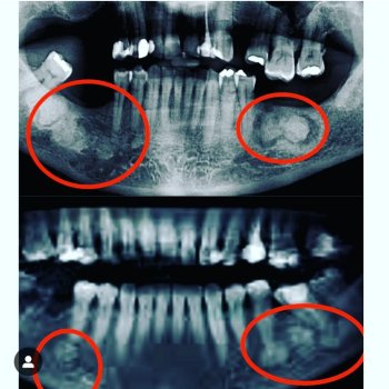 Displasias Fibro -Ósseas